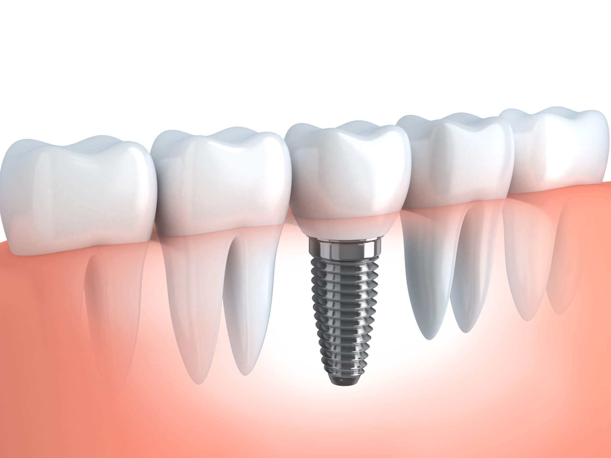 Is There an Age Limit for Dental Implants?