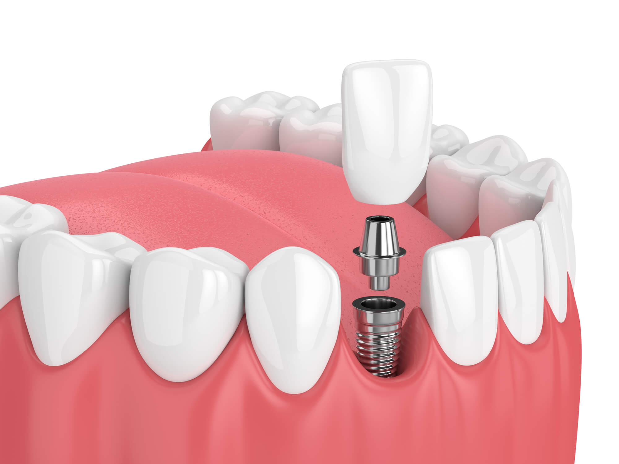 Common Problems With Dentures That Implants Can Solve