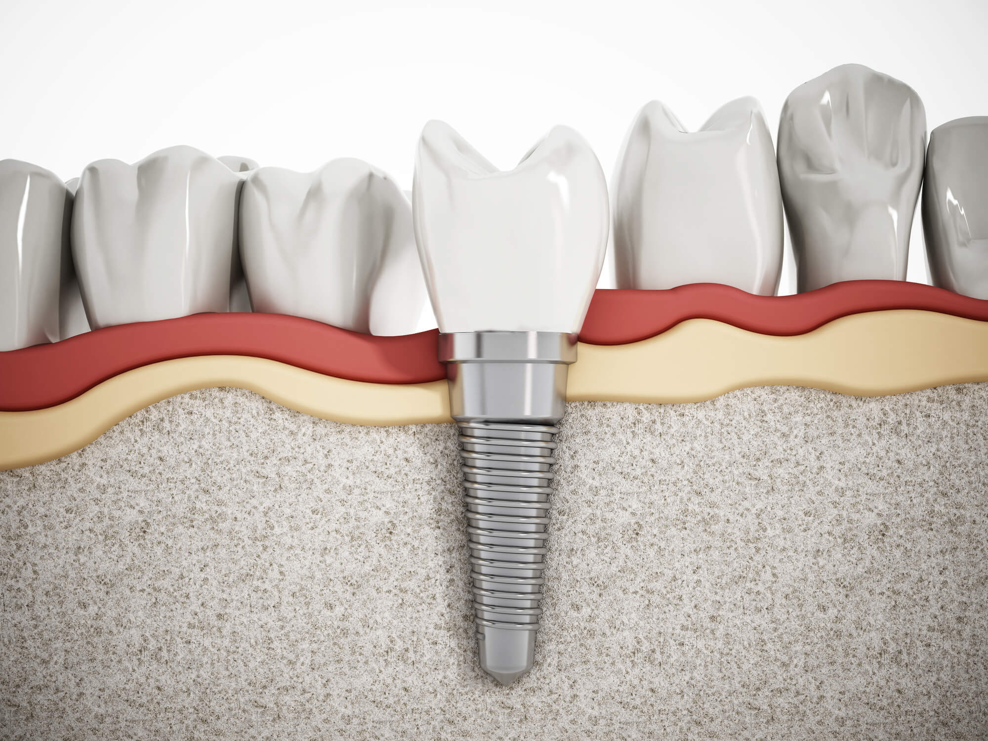 Dentures Versus Dental Implants