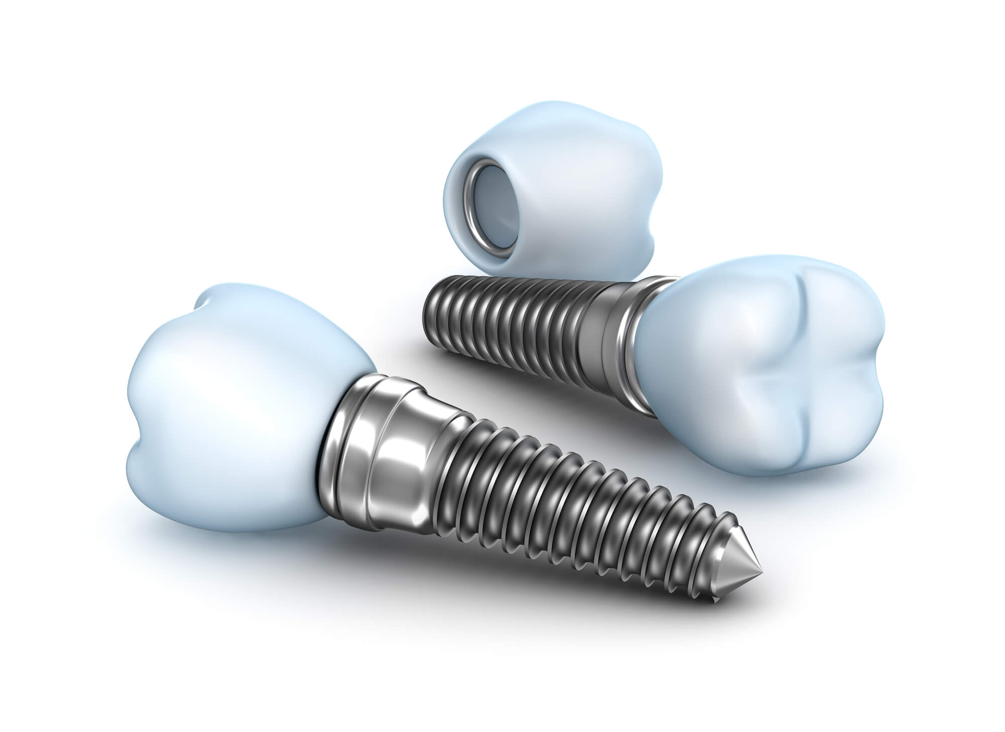 Are There Any Downsides to Dental Implants?