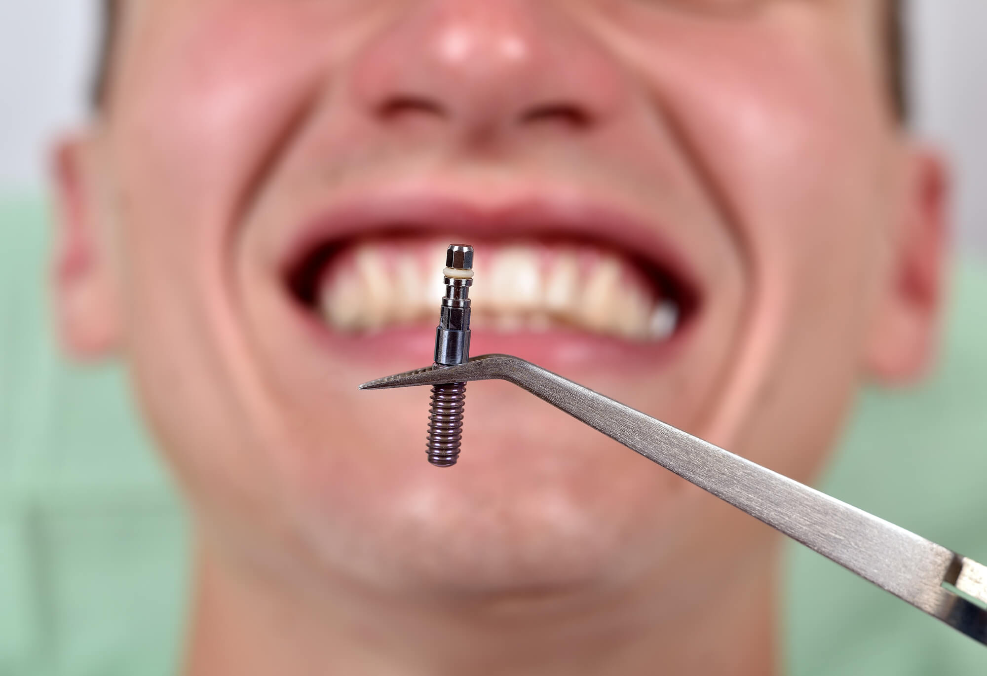 Is Dental Implant Painful