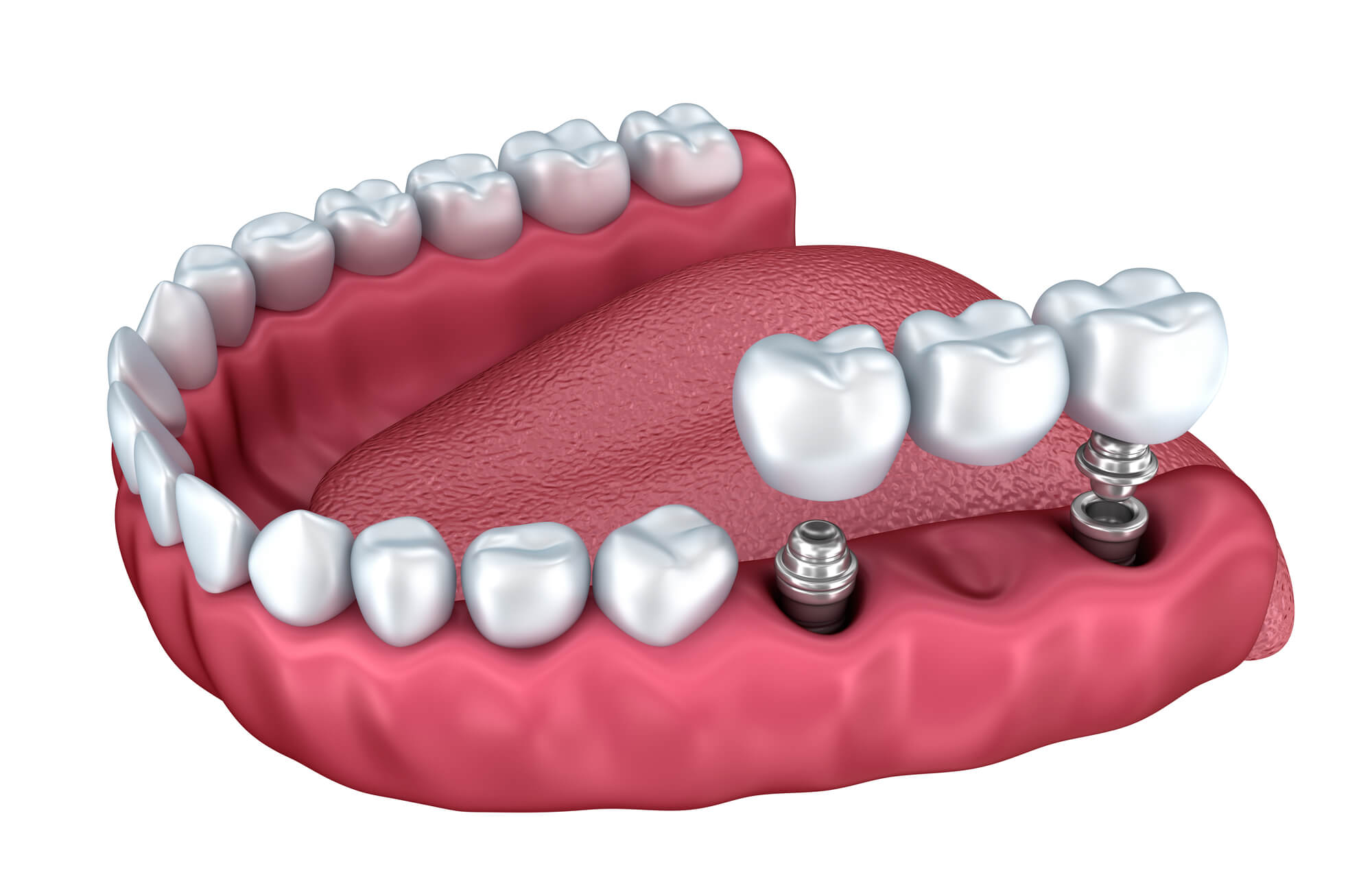 What Happens if I Don’t Get Dental Implants?