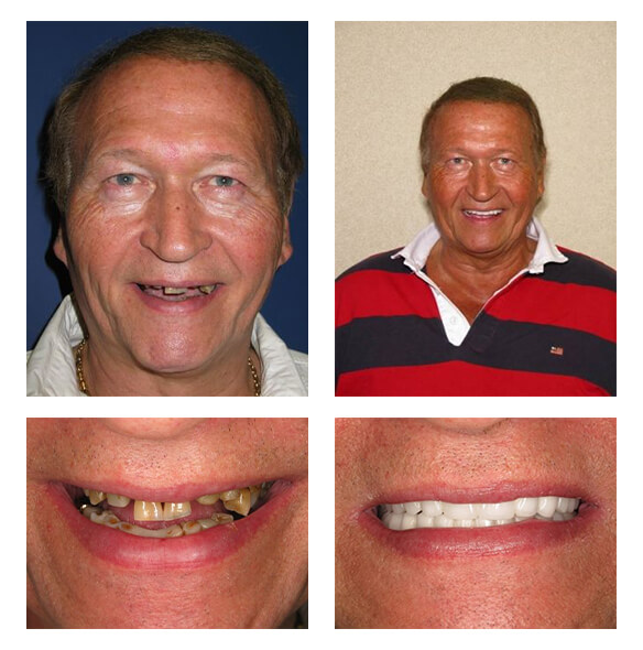 A collage of before and after photos of a male patient of PGA Dentistry.