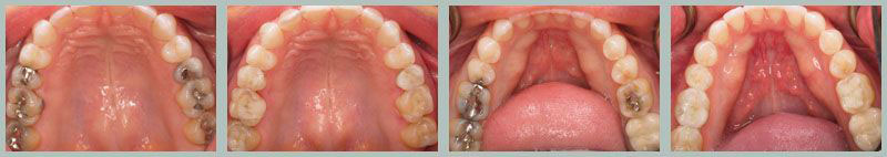 Closeup of an arch of teeth with silver fillings.