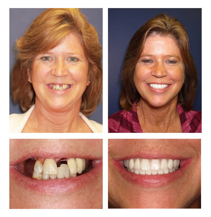 A collage of before and after photos of a female patient of PGA Dentistry.
