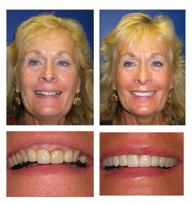 A collage of before and after photos of a patient, Bonnie of PGA Dentistry.