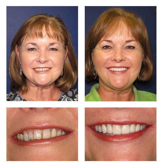 A collage of before and after photos of a patient, Elaine of PGA Dentistry.