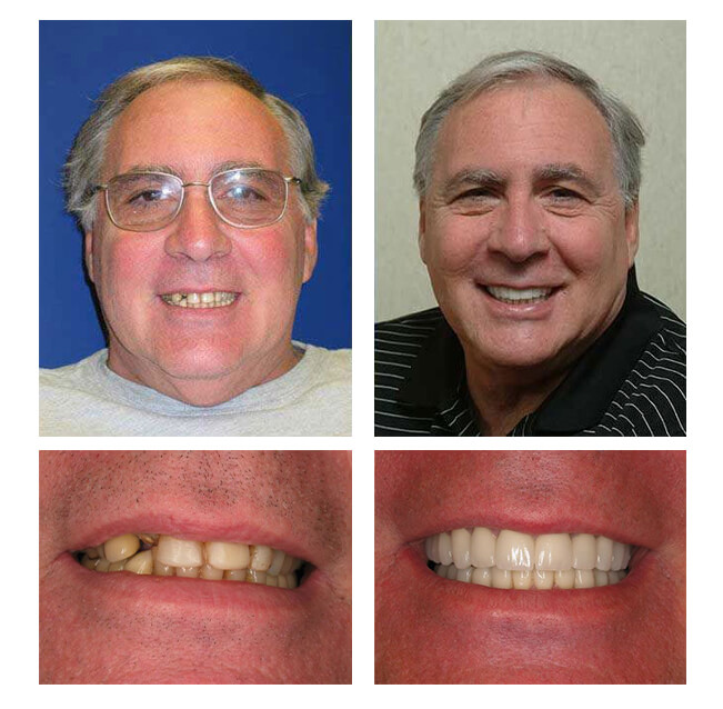 A collage of before and after photos of a patient, George of PGA Dentistry.