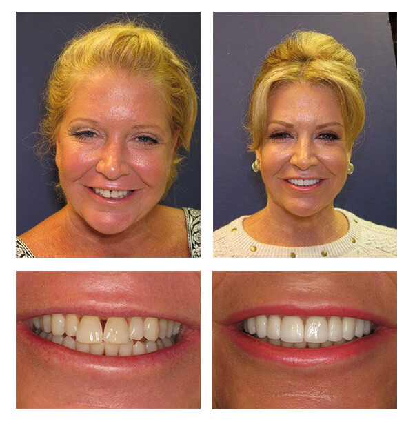 A collage of before and after photos of a patient, Katherine of PGA Dentistry.