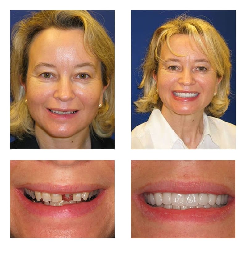 A collage of before and after photos of a female patient of PGA Dentistry.