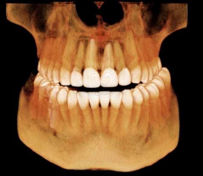 A CT scan of a person's jaw.