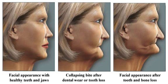 A collage of a woman's face progressing after tooth and bone loss.