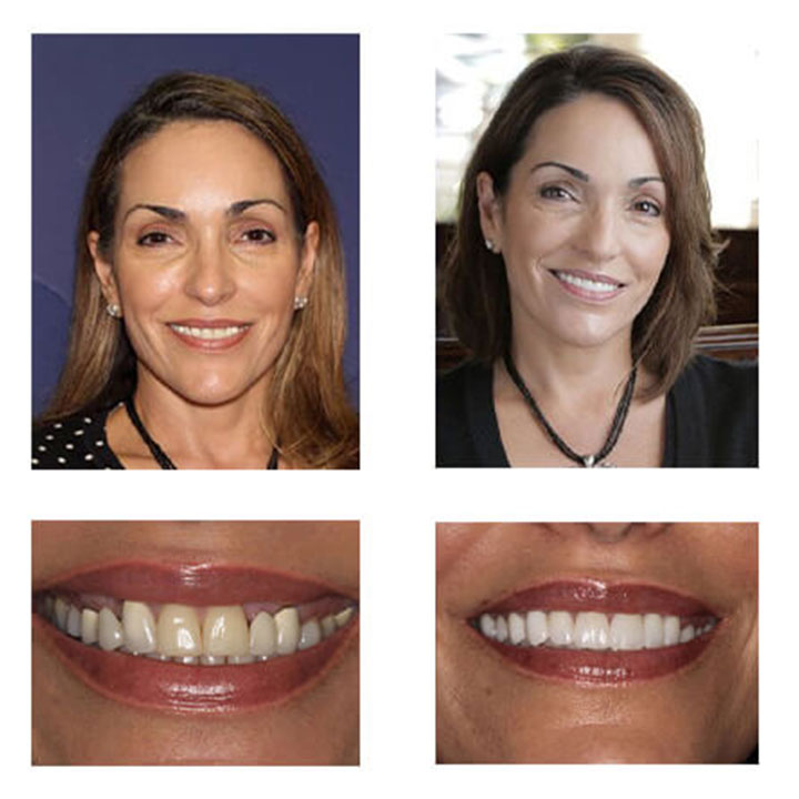 A collage of before and after photos of a patient of PGA Dentistry.