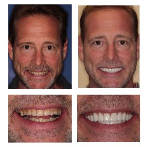 porcelain veneers at PGA Dentistry