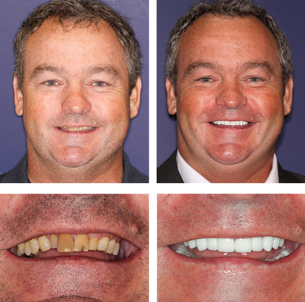 A collage of before and after photos of a patient, Tim of PGA Dentistry.