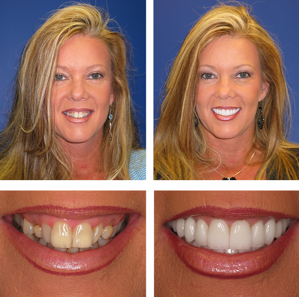 A collage of before and after photos of a female patient of PGA Dentistry.