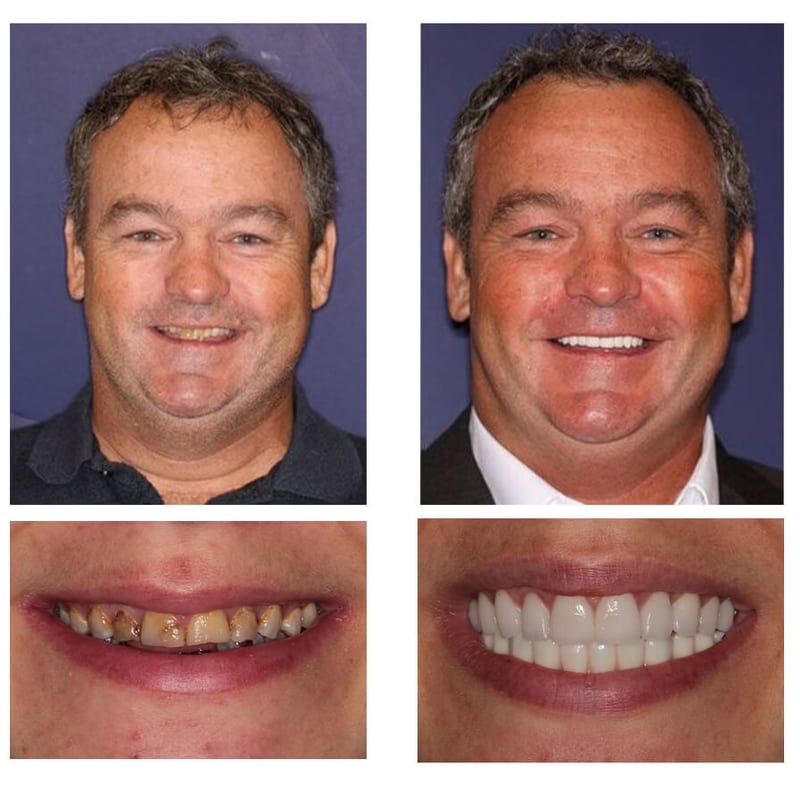 A collage of before and after photos of a patient, Tim of PGA Dentistry.