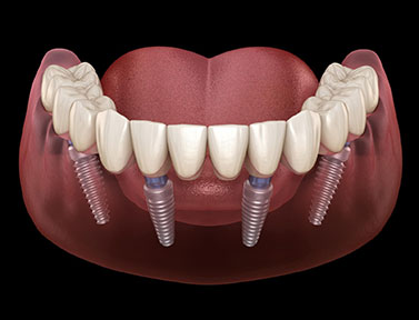 4-implant-overdenture