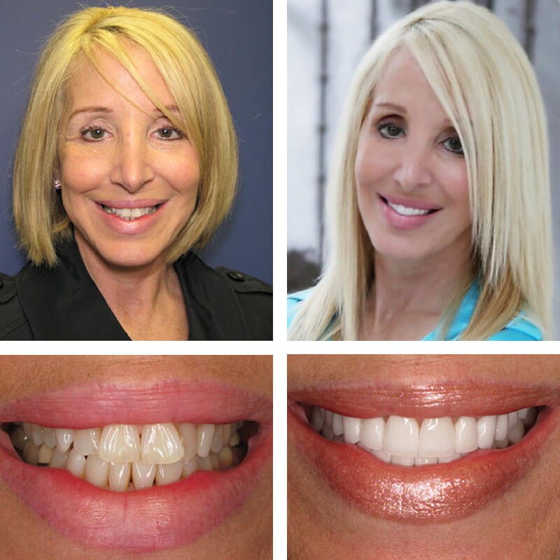 A collage of before and after photos of a patient of PGA Dentistry.