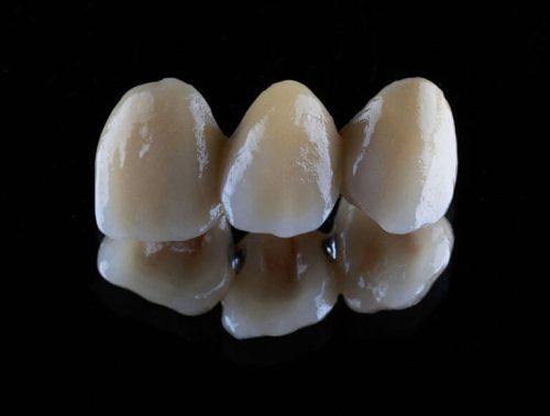 Dental Bridge