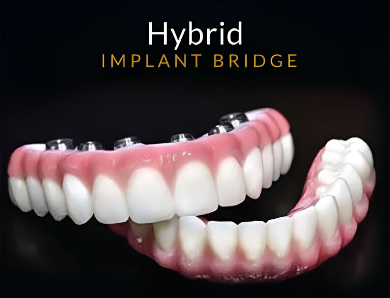 Hybrid Implant Bridge