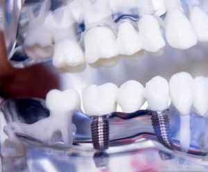 dental bridges