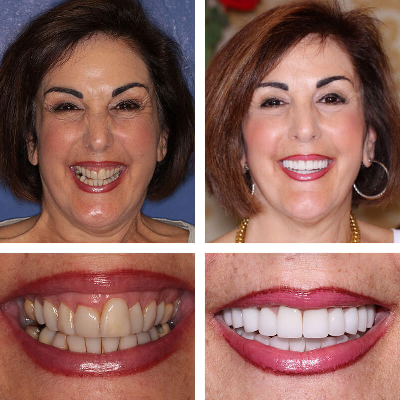 A collage of before and after photos of a patient, Patricia of PGA Dentistry.
