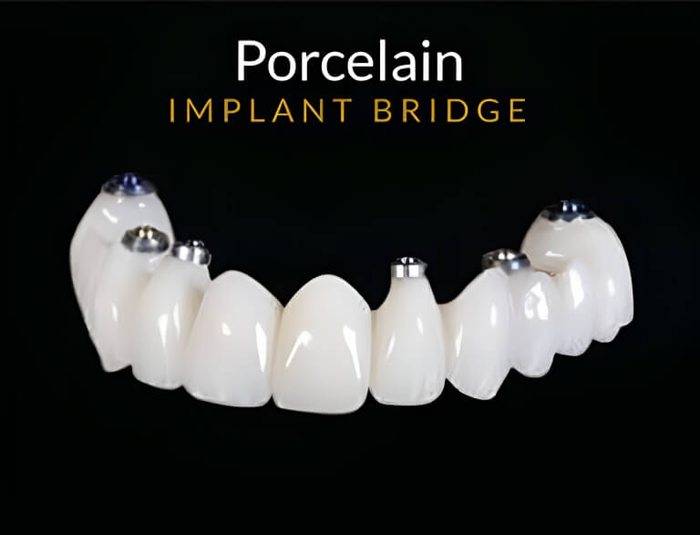 Porcelain Implant Bridge