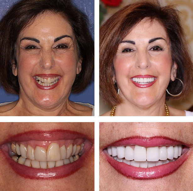 A collage of before and after photos of a patient, Patricia of PGA Dentistry.