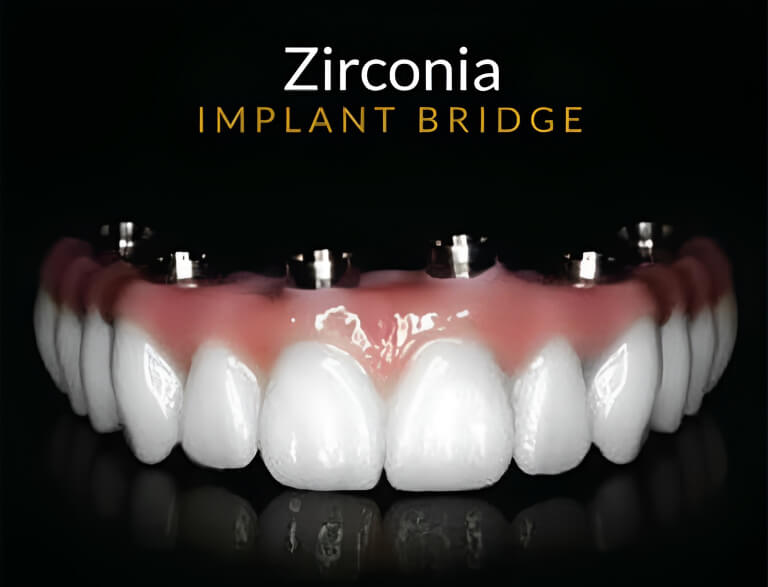 Zirconia Implant Bridge