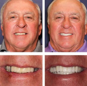 Smile transformation at PGA Dentistry