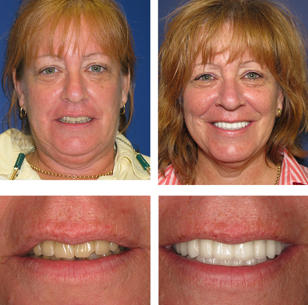 Smile Transformation at PGA Dentistry