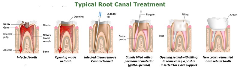 root canal proceedure