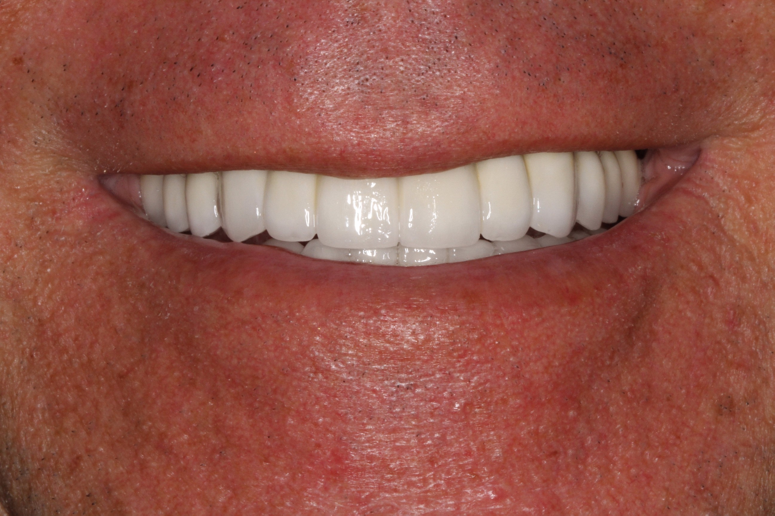 Close-up of a smiling mouth showcasing a full set of bright, white dental implants after a full mouth reconstruction, reflecting successful dental treatment at PGA Dentistry.