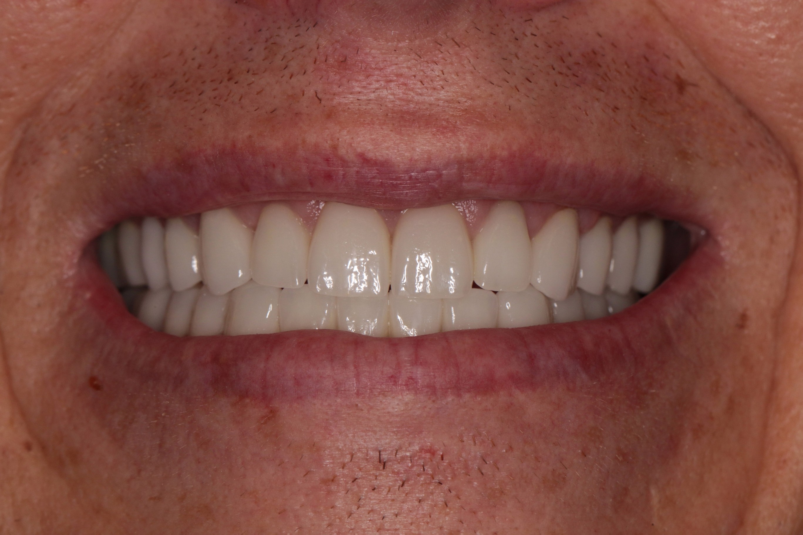 Full mouth reconstruction result showcasing a bright, even smile with porcelain crowns, highlighting dental transformation and improved aesthetics.