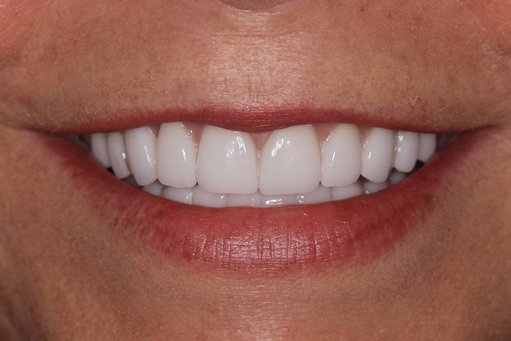 Close-up of a woman's smile showcasing bright, white porcelain veneers, highlighting the results of a cosmetic smile makeover at PGA Dentistry.
