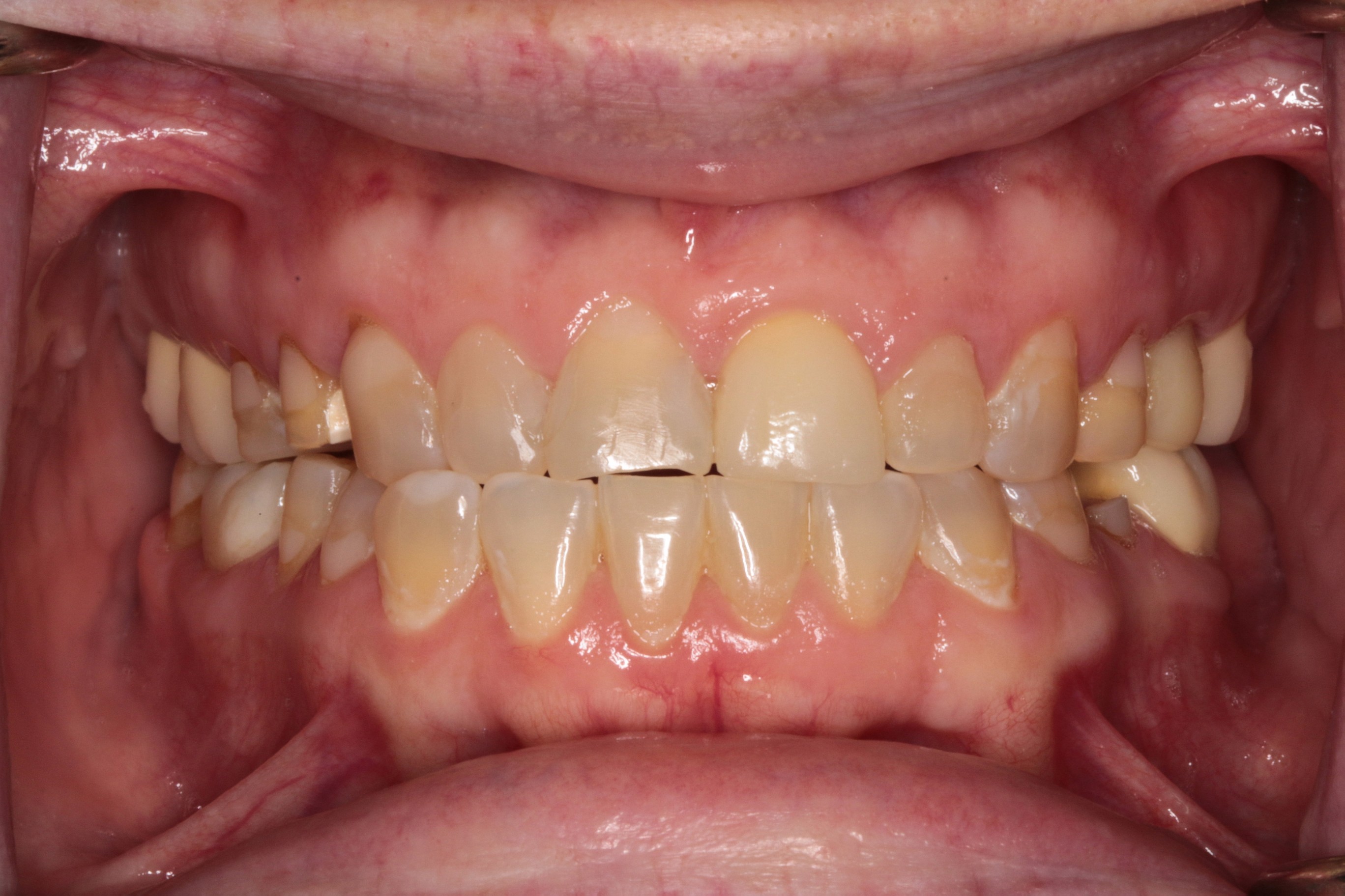 Full mouth view of teeth showing underbite, decay, and older crowns, highlighting dental issues prior to reconstruction treatment at PGA Dentistry.