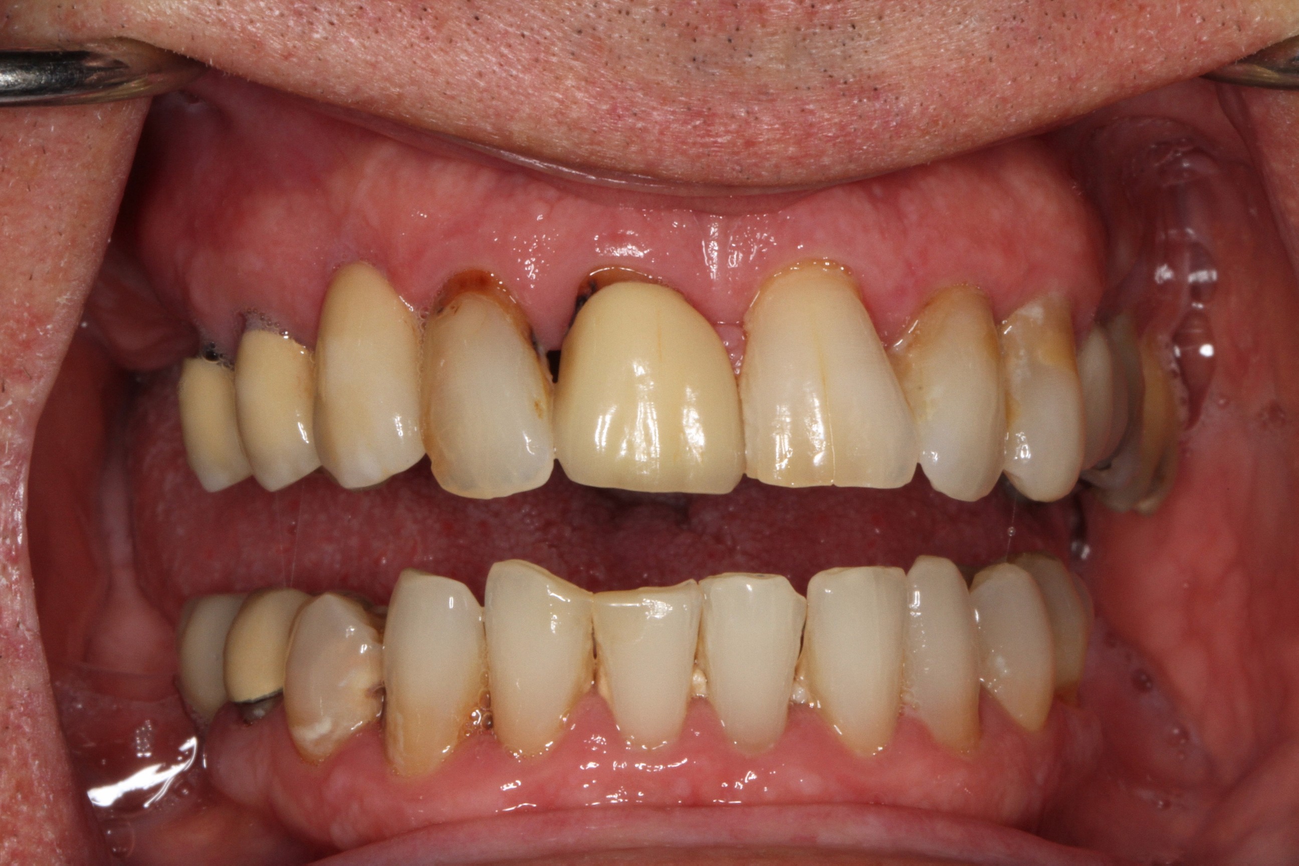 Close-up of a patient's upper and lower teeth showing significant discoloration and gum issues, illustrating advanced periodontal disease prior to full mouth reconstruction at PGA Dentistry.