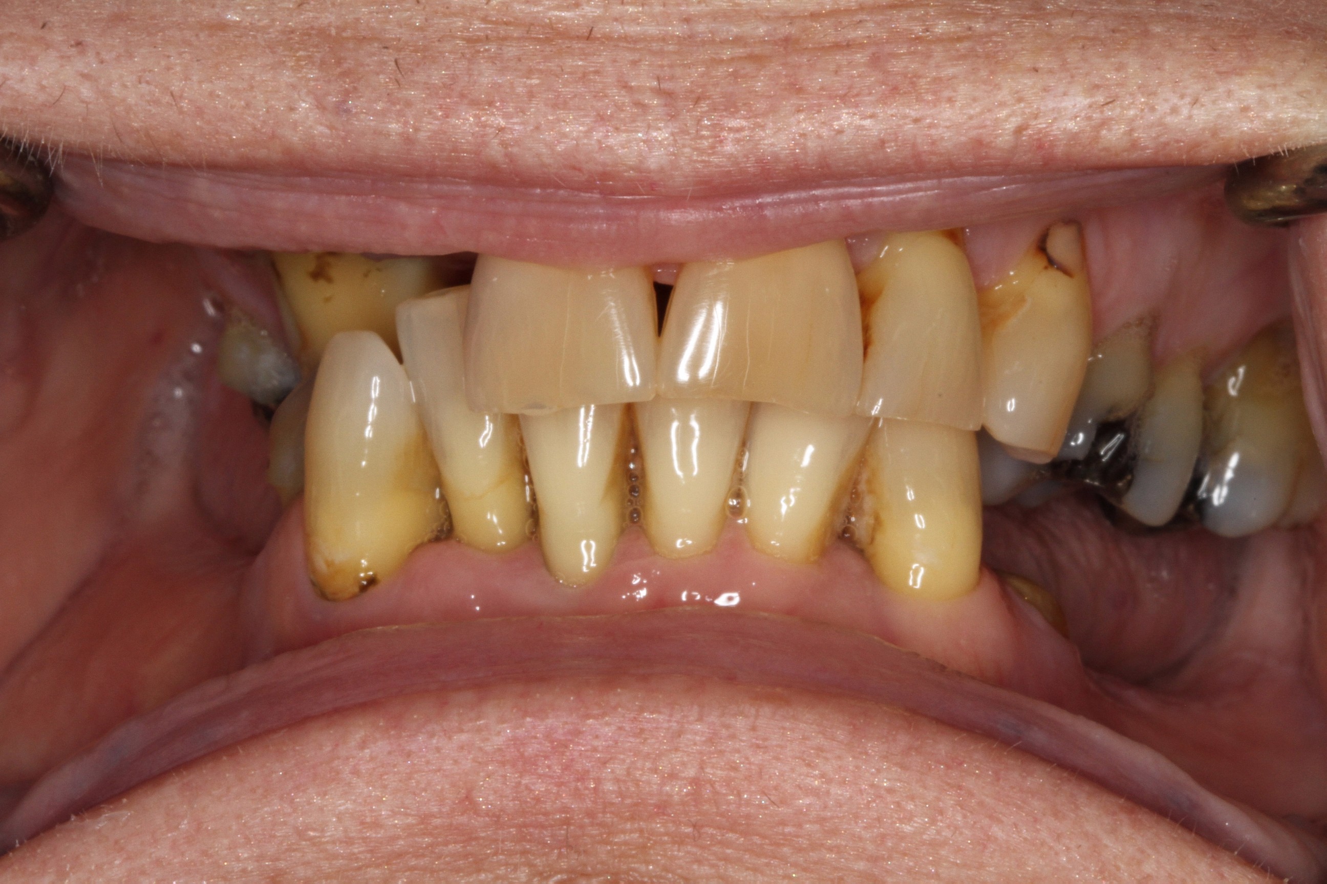 Before treatment condition of Linda's teeth showing significant deterioration, discoloration, and missing dental structures, highlighting the need for full mouth cosmetic porcelain bridgework at PGA Dentistry.