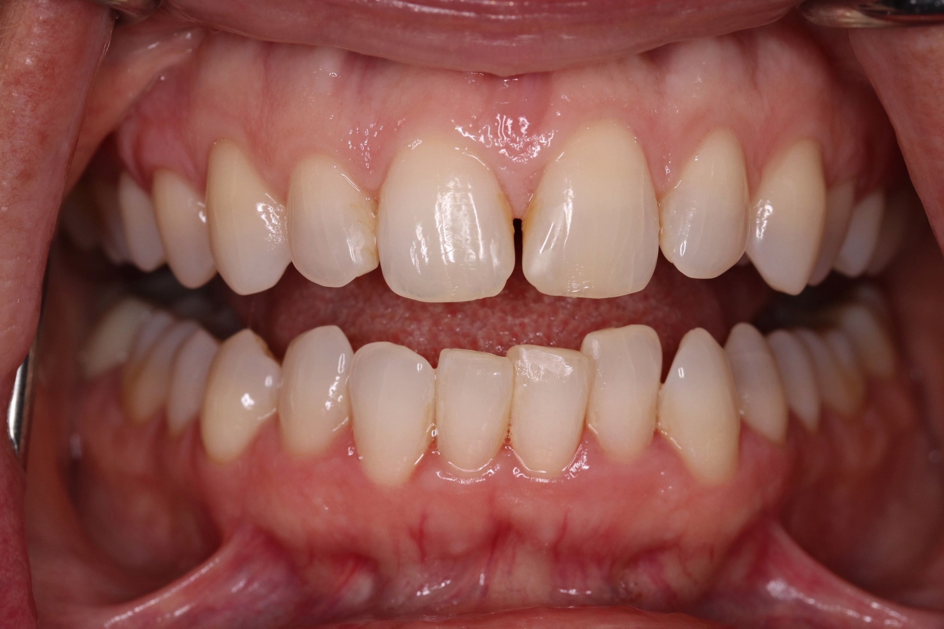 Close-up of a patient's teeth showing chipping, misalignment, and a gap between the front teeth, illustrating dental issues addressed in Deborah's smile makeover with porcelain veneers.