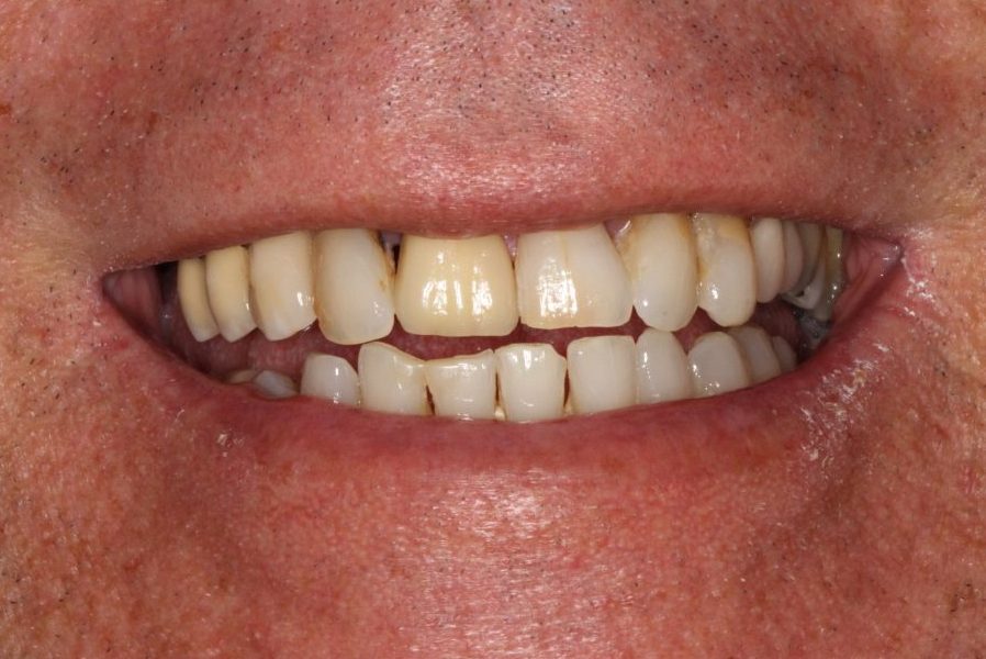 Close-up of a person's smile showcasing dental implants, highlighting improved aesthetics and oral health after full mouth reconstruction at PGA Dentistry.