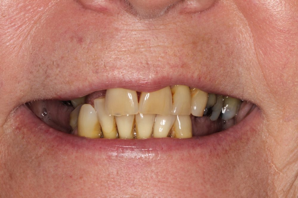 Close-up of a patient's smile showing discolored and misaligned teeth, highlighting the dental issues addressed in comprehensive treatment at PGA Dentistry.