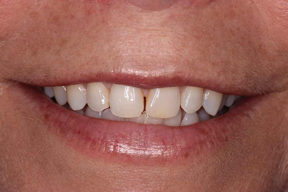 Close-up of a woman's smile showcasing porcelain veneers, highlighting a bright, natural-looking set of teeth and healthy gums, reflecting a successful smile makeover by PGA Dentistry.