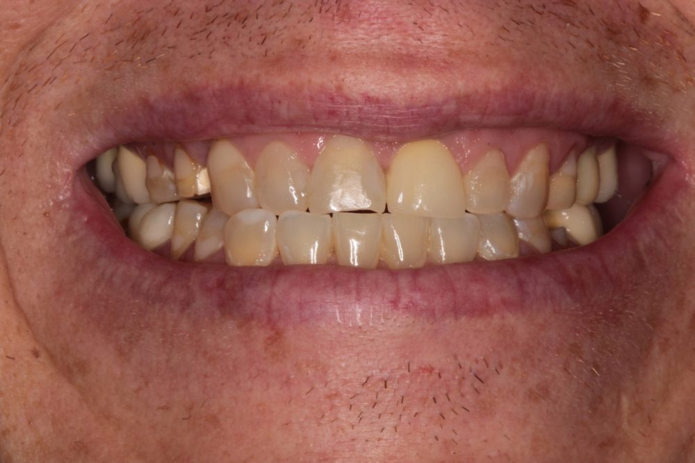Close-up of a person's smile showing dental issues, including an underbite and uneven teeth, representing challenges faced before treatment at PGA Dentistry.