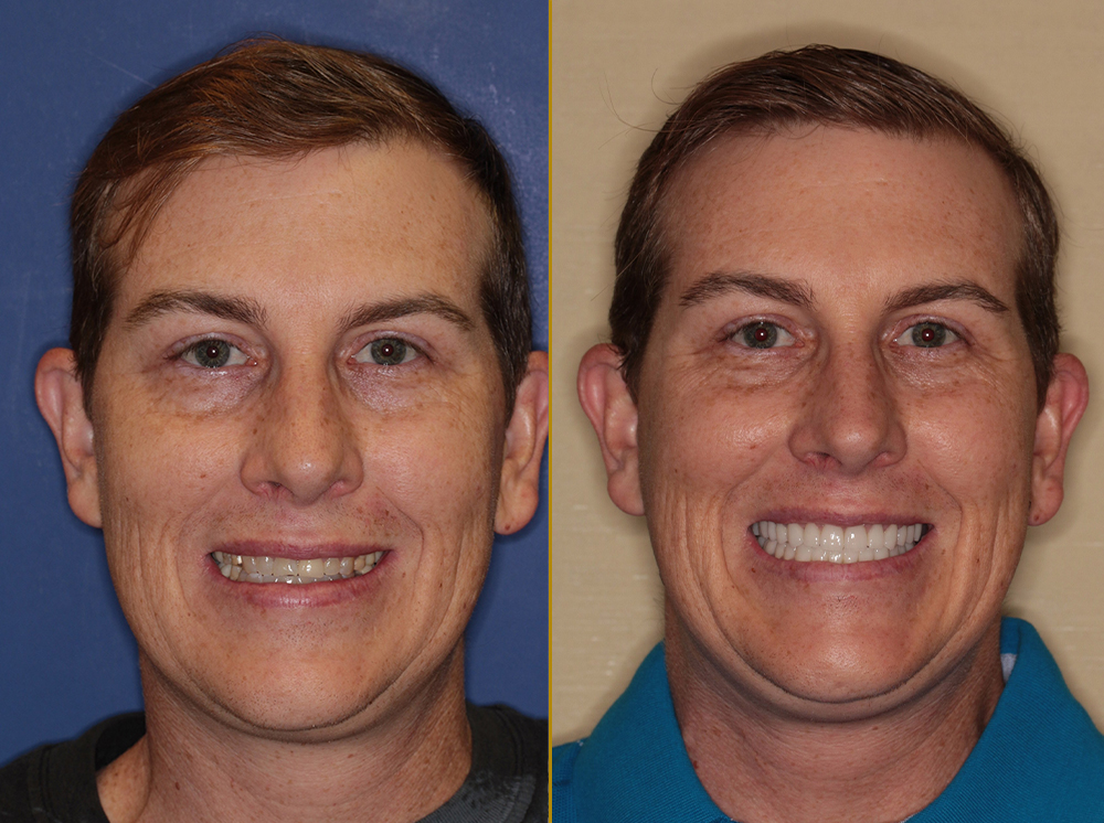 John's smile transformation after full mouth reconstruction, showcasing before (left) and after (right) results with porcelain crowns, highlighting improved aesthetics and bite correction.