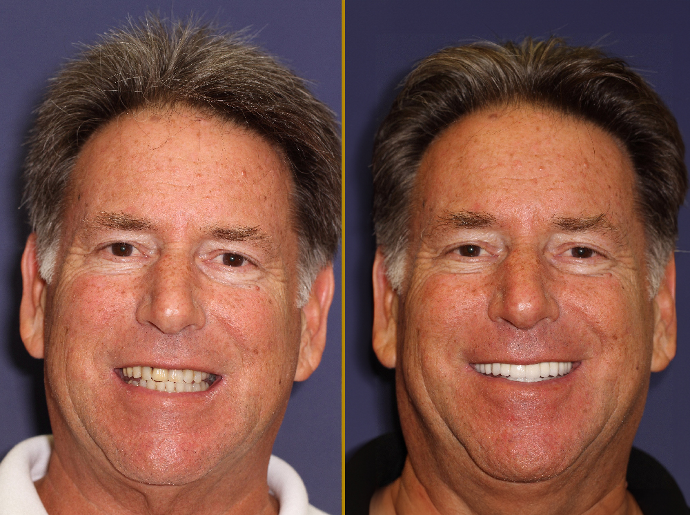 Before and after images of a male patient showcasing full mouth reconstruction results, highlighting improved dental aesthetics and smile transformation following treatment at PGA Dentistry.