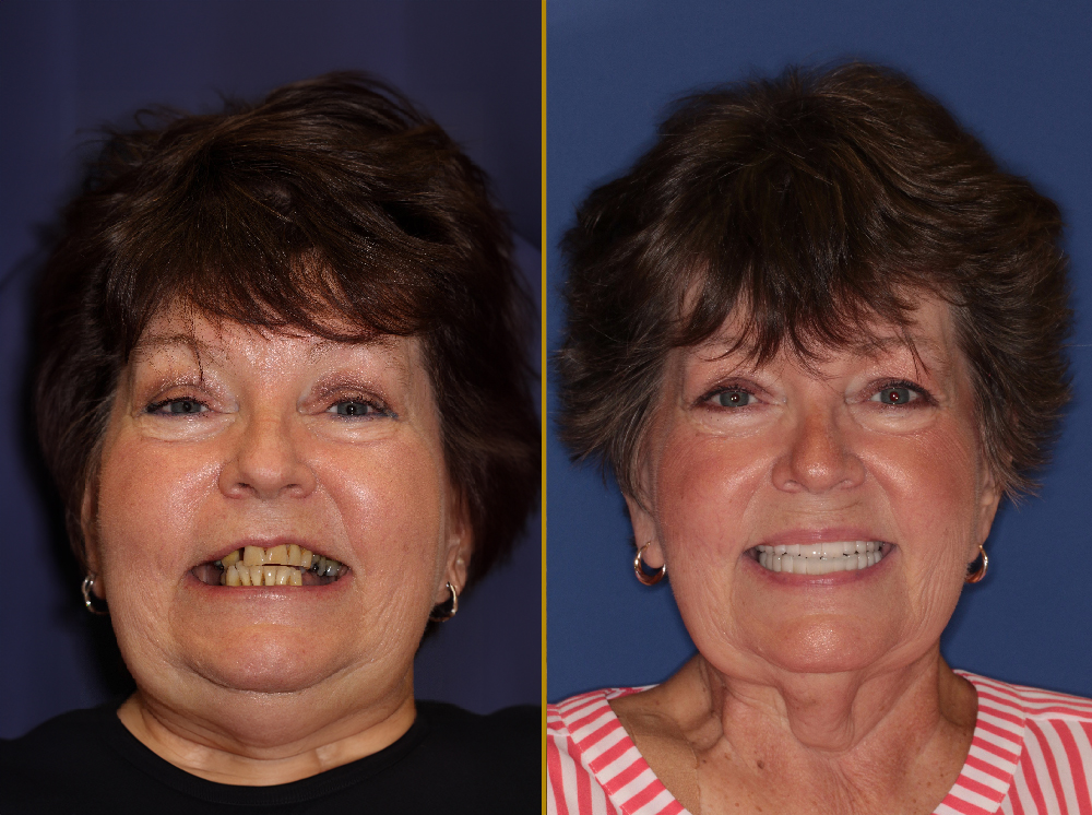 Before and after images of a woman showcasing her smile transformation through full mouth cosmetic porcelain bridgework at PGA Dentistry, highlighting significant dental restoration results.