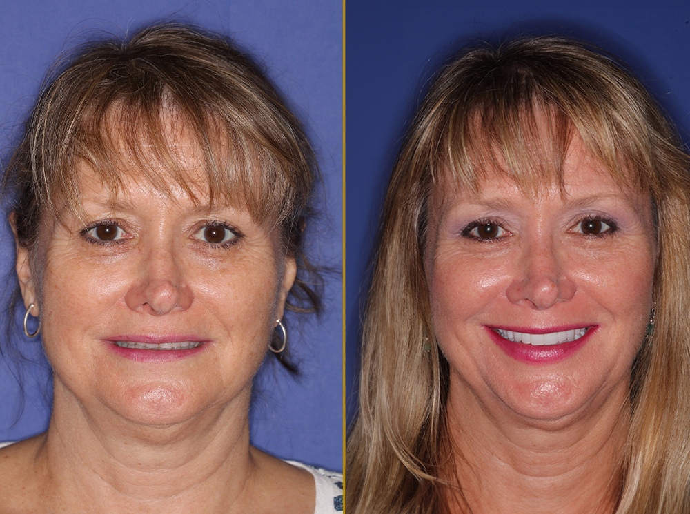 Before and after images of a woman showcasing the results of a full mouth reconstruction, featuring improved smile aesthetics and dental restoration.