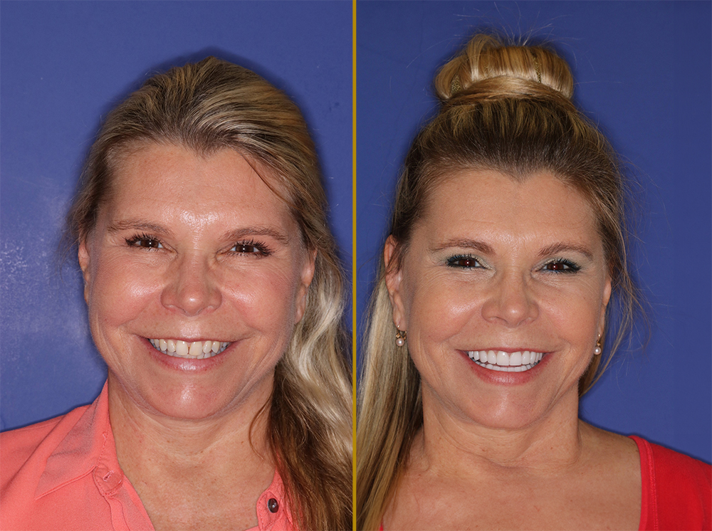 Before and after images of a woman showcasing a smile makeover with porcelain veneers, highlighting improved alignment, a bright, youthful appearance, and a confident smile.