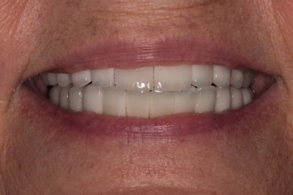 Close-up of a woman's smile showcasing cosmetic porcelain bridgework, highlighting dental restoration results from PGA Dentistry's full mouth rehabilitation services.